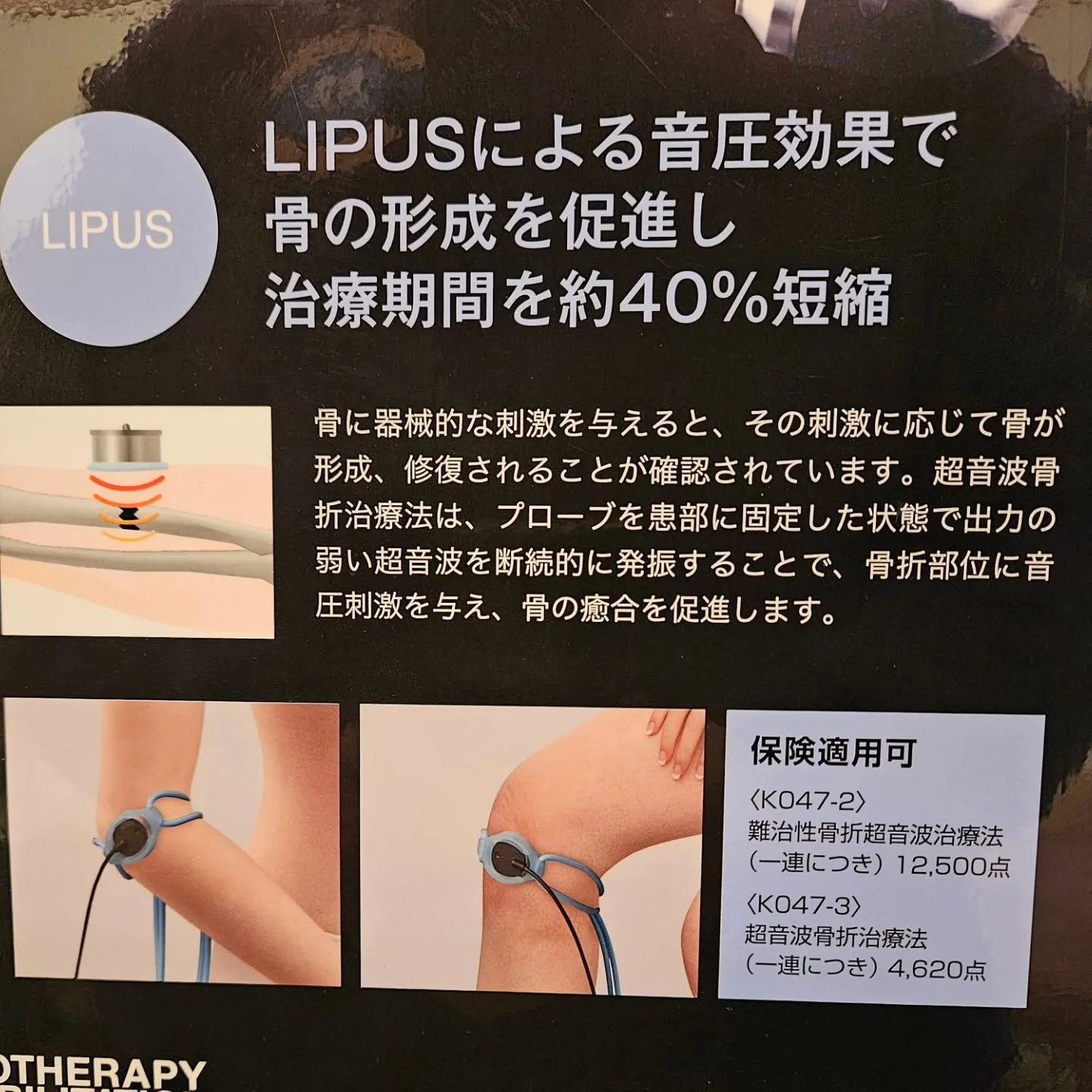 超音波治療『LIPUS 治療』