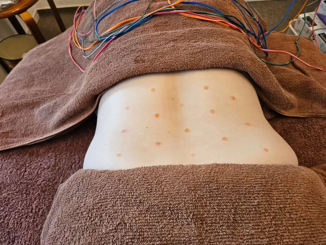 お灸で腰痛治療　