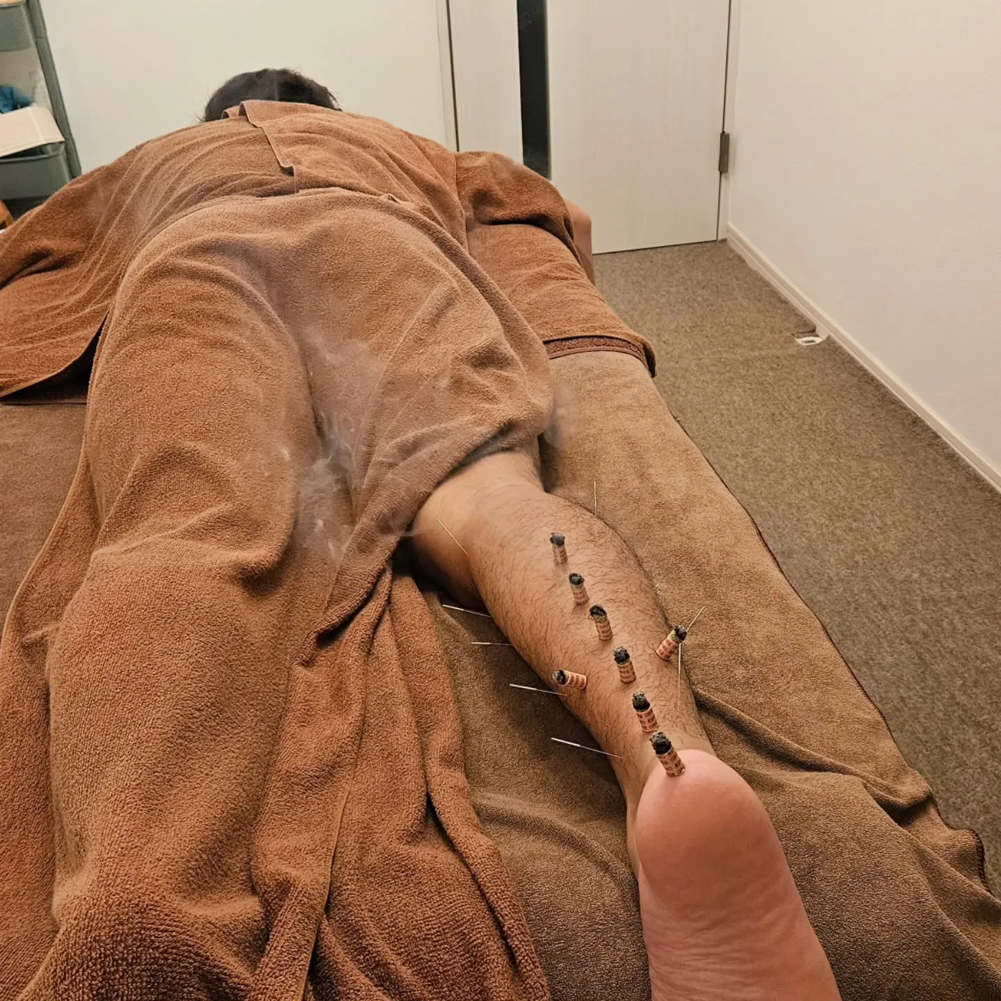 アキレス腱の痛み治療