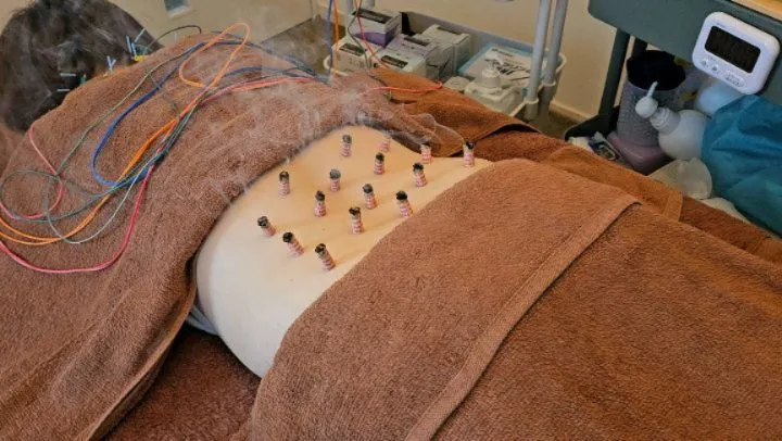 お灸で腰痛治療　
